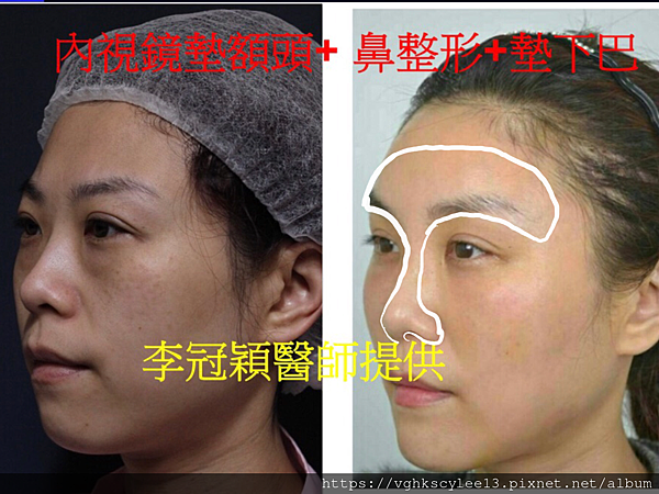 搶救隆鼻失敗(一)(二次重修鼻):隆鼻後反而要蓋劉海為什麼? 搶救隆鼻失敗(一)(二次重修鼻):隆鼻後反而要蓋劉海為什麼?