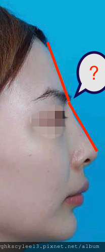 搶救隆鼻失敗(一)(二次重修鼻):隆鼻後反而要蓋劉海為什麼? 搶救隆鼻失敗(一)(二次重修鼻):隆鼻後反而要蓋劉海為什麼?