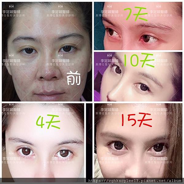 搶救隆鼻失敗(一)(二次重修鼻):隆鼻後反而要蓋劉海為什麼? 搶救隆鼻失敗(一)(二次重修鼻):隆鼻後反而要蓋劉海為什麼?