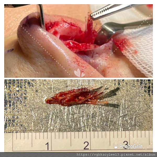 隆鼻價位多少?為什麼差異大!原因? 隆鼻價位多少?為什麼差異大!原因?