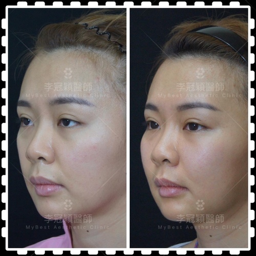 8B590A8F-5468-4395-9313-C722AE468E72.JPG - 蘋果肌墊片貓咪紋問題