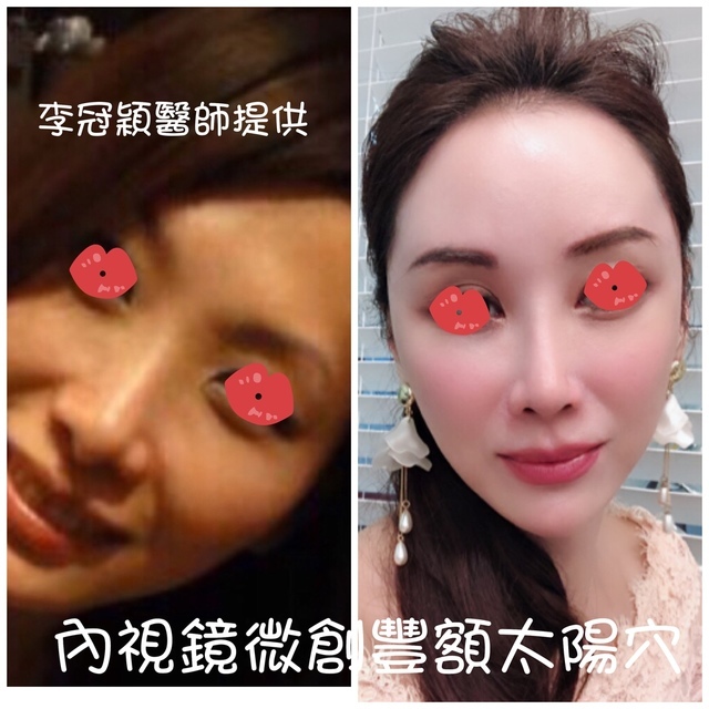 還在注射豐額頭嗎? 微創內視鏡精準豐額頭（墊額頭）不再讓妳掀