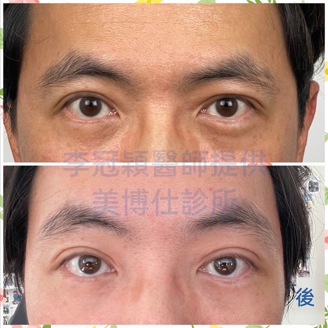 92CE2F04-081A-4EEC-B7B1-4E6EAB5EA7B3.JPG - 內視鏡提眉