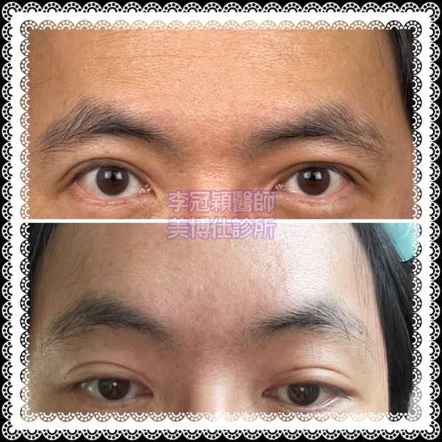 D6941511-EF52-46FA-9630-2C949E68EBB6.JPG - 內視鏡提眉