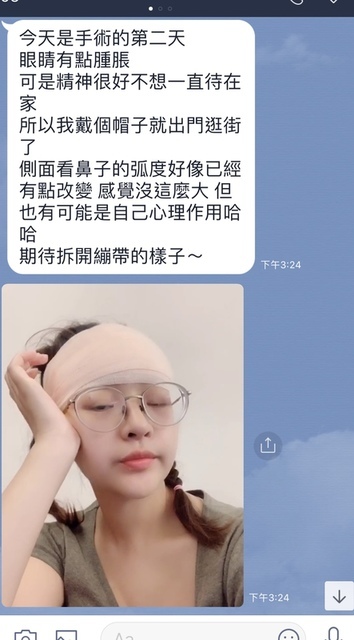 豐額／墊眉骨過渡期多久？傷口在哪裡？墊額頭會不會很腫跟瘀青？