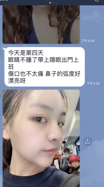 豐額／墊眉骨過渡期多久？傷口在哪裡？墊額頭會不會很腫跟瘀青？