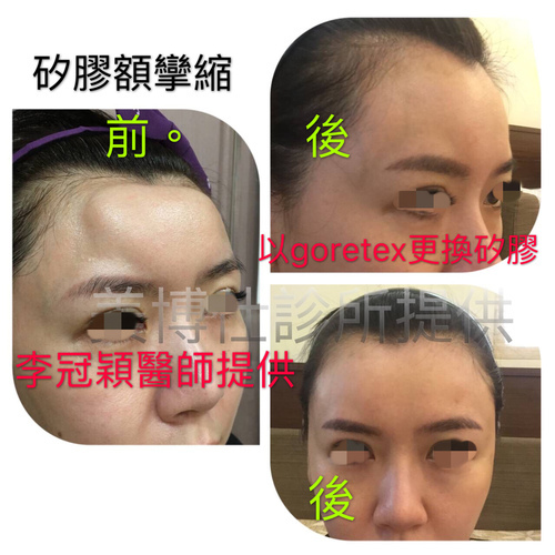 豐額／墊眉骨過渡期多久？傷口在哪裡？墊額頭會不會很腫跟瘀青？