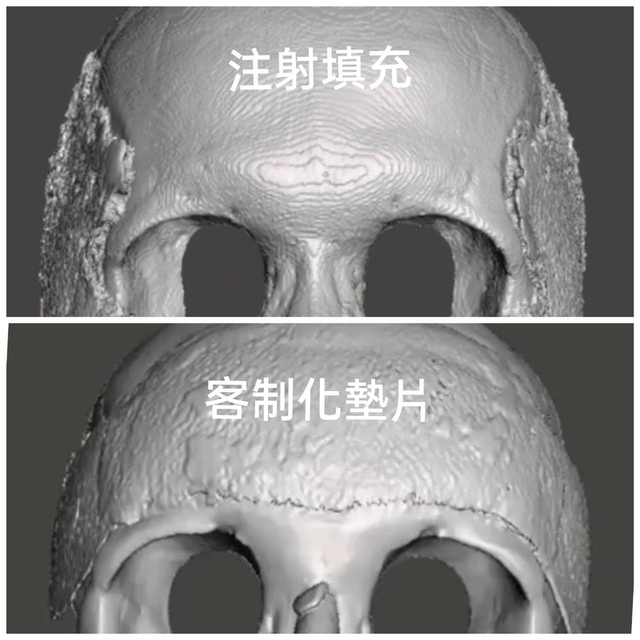 豐太陽穴凹陷：太陽穴( 夫妻宮) 凹陷如何處理?