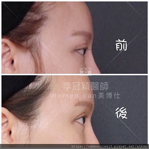 為何你有泡泡眼?凸眼有甚麼不同?只有割眼皮抽脂嗎？錯！