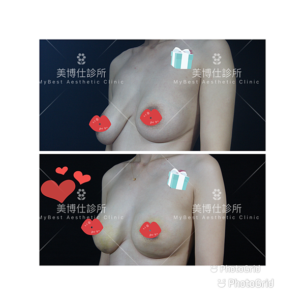 不對稱與垂乳整形