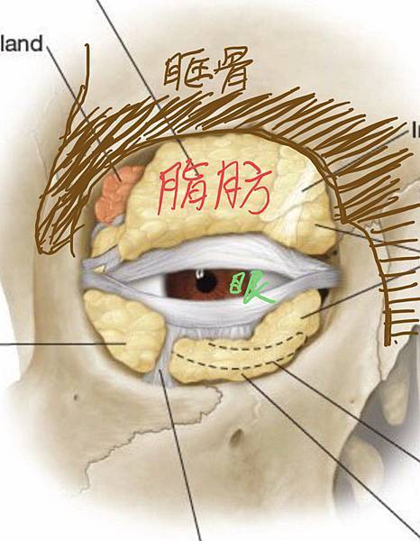 為何你有泡泡眼?凸眼有甚麼不同?只有割眼皮抽脂嗎？錯！