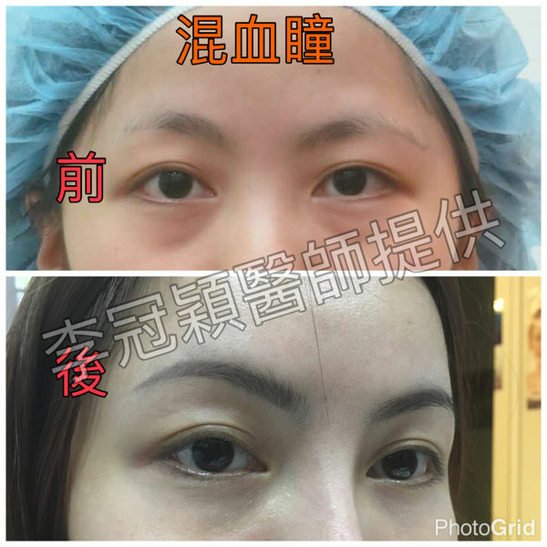 為何你有泡泡眼?凸眼有甚麼不同?只有割眼皮抽脂嗎？錯！