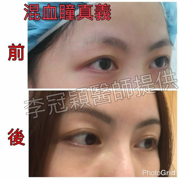 為何你有泡泡眼?凸眼有甚麼不同?只有割眼皮抽脂嗎？錯！