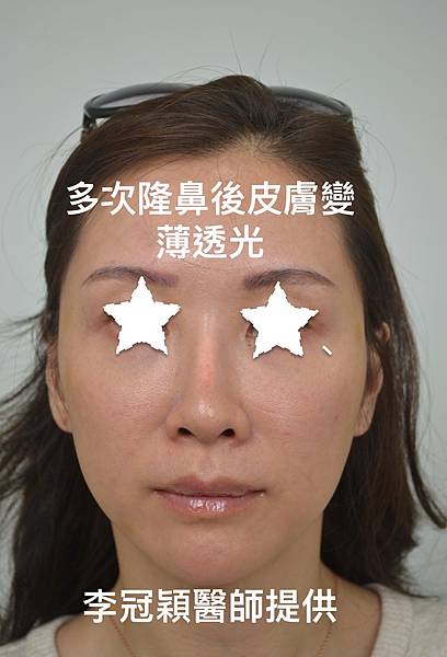 隆鼻價位多少?為什麼差異大!原因?