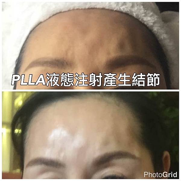 豐額頭或改善額型的方式有那些？它們的優缺點妳明白嗎？