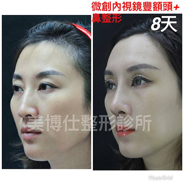 還在注射豐額頭嗎? 微創內視鏡精準豐額頭（墊額頭）不再讓妳掀