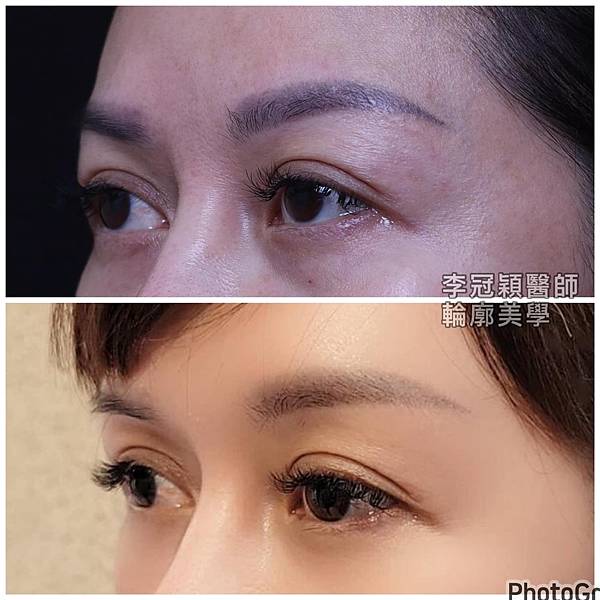 為何你有泡泡眼?凸眼有甚麼不同?只有割眼皮抽脂嗎？錯！