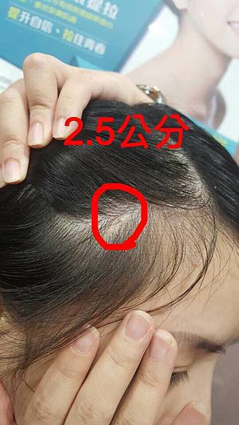 豐額／墊眉骨過渡期多久？傷口在哪裡？墊額頭會不會很腫跟瘀青？