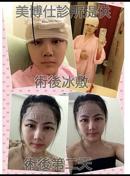 豐額／墊眉骨過渡期多久？傷口在哪裡？墊額頭會不會很腫跟瘀青？