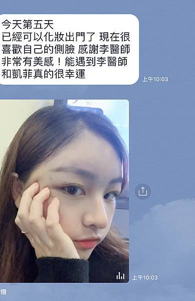豐額／墊眉骨過渡期多久？傷口在哪裡？墊額頭會不會很腫跟瘀青？