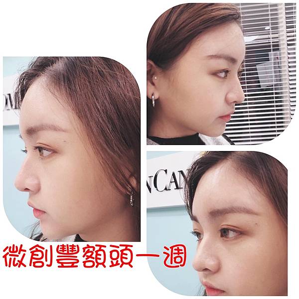 豐額／墊眉骨過渡期多久？傷口在哪裡？墊額頭會不會很腫跟瘀青？