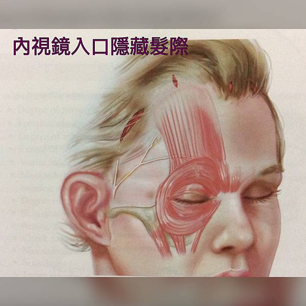豐額／墊眉骨過渡期多久？傷口在哪裡？墊額頭會不會很腫跟瘀青？