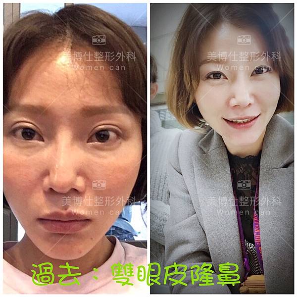 豐額／墊眉骨過渡期多久？傷口在哪裡？墊額頭會不會很腫跟瘀青？