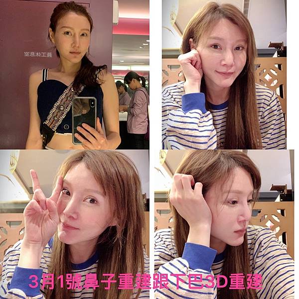 豐額／墊眉骨過渡期多久？傷口在哪裡？墊額頭會不會很腫跟瘀青？