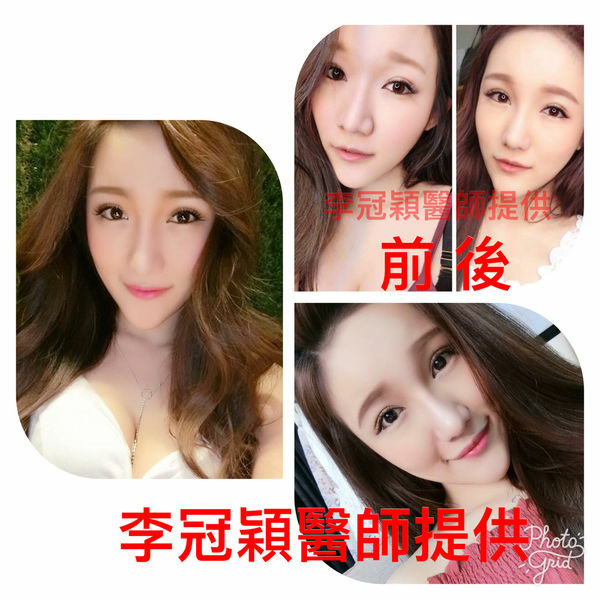 搶救隆鼻失敗(一)(二次重修鼻):隆鼻後反而要蓋劉海為什麼? 搶救隆鼻失敗(一)(二次重修鼻):隆鼻後反而要蓋劉海為什麼?