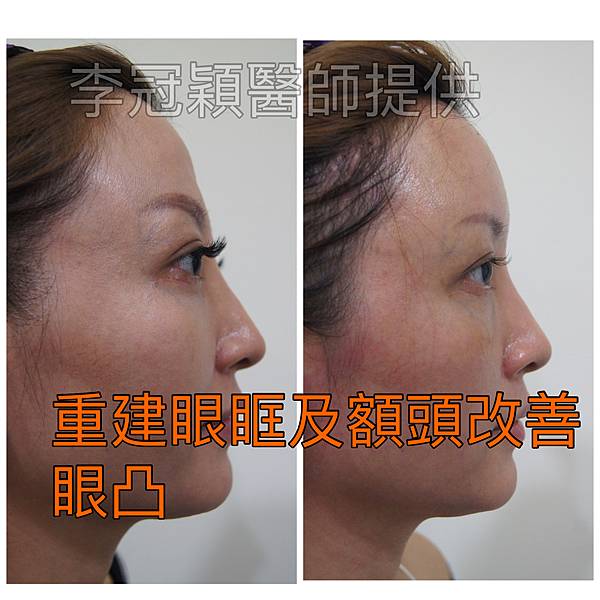 搶救隆鼻失敗(一)(二次重修鼻):隆鼻後反而要蓋劉海為什麼? 搶救隆鼻失敗(一)(二次重修鼻):隆鼻後反而要蓋劉海為什麼?