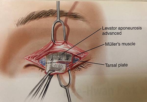 提眼肌無力矯正