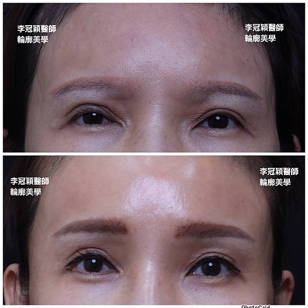 豐額頭或改善額型的方式有那些?它們的優缺點妳明白嗎?