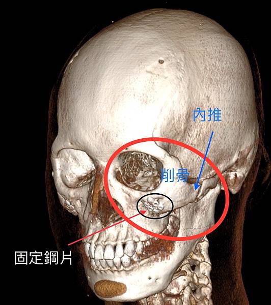 削骨重建