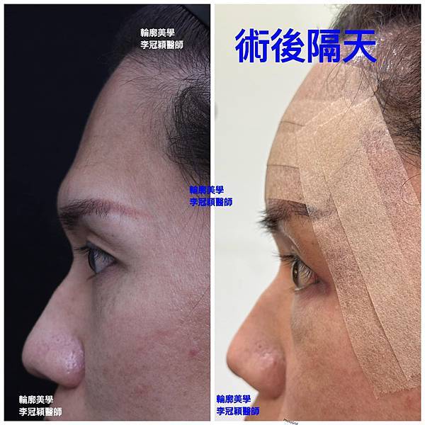 豐額／墊眉骨過渡期多久？傷口在哪裡？墊額頭會不會很腫跟瘀青？