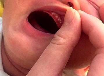 媽咪why 1 嬰兒口腔有乳白塊狀物 奶垢 鵝口瘡 珍珠瘤 菲腸愛旅行 痞客邦