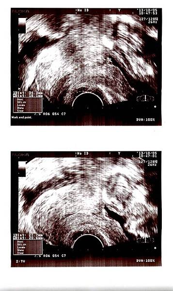 20131005-14W0D-7（子宮頸長度）