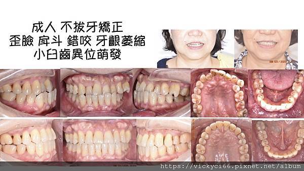 inv 異位萌牙 戽斗