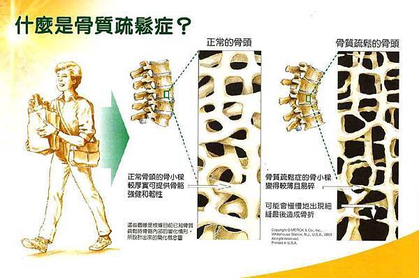 骨質疏鬆