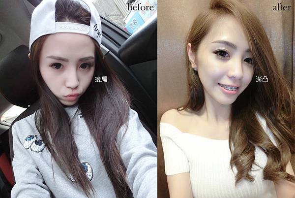 蘋果肌對比2.jpg
