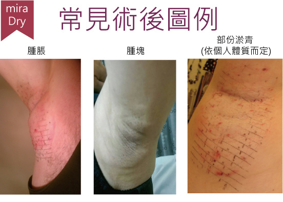 常見的副作用 常見的副作用