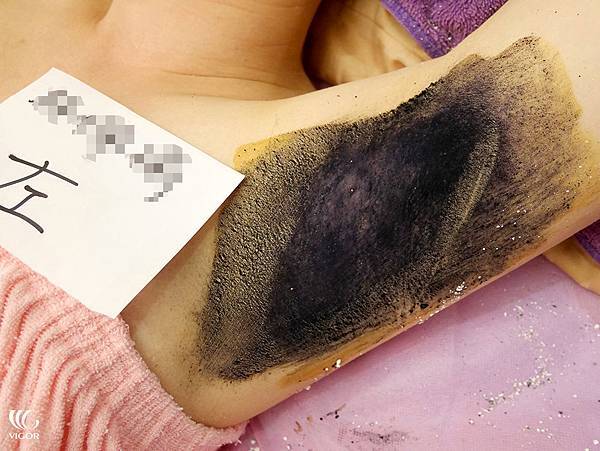 Miradry多汗症 腋下尷尬不已 Miradry讓腋汗異味退散 美麗見證 維格醫美 皮秒雷射 微整 整型 私密處雷射 隆乳 減脂 Miradry多汗症 腋下尷尬不已 Miradry讓腋汗異味退散 美麗見證 維格醫美 皮秒雷射 微整 整型 私密處雷射 隆乳 減脂