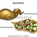 stock-photo-gallstones-77128189[1].jpg