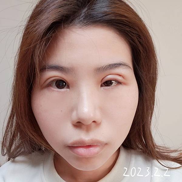 割与缝双眼皮手术纪录 (4).jpg