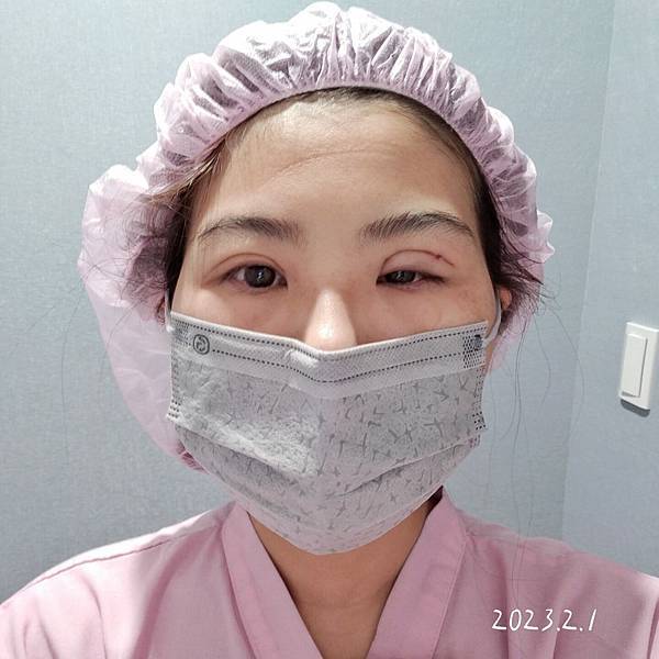 割与缝双眼皮手术纪录 (6).jpg