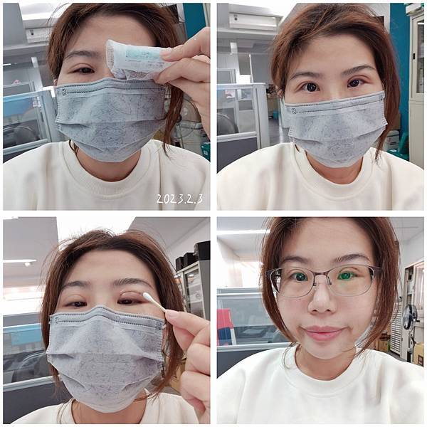 割与缝双眼皮手术纪录 (3).jpg
