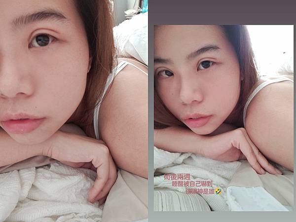 割与缝双眼皮手术纪录 (19).jpg