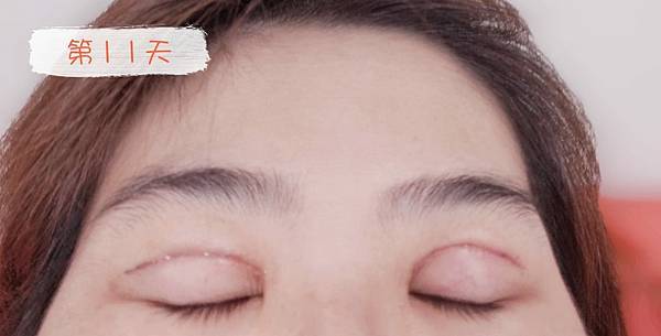 割与缝双眼皮手术纪录 (20).jpg