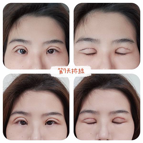 割与缝双眼皮手术纪录 (22).jpg
