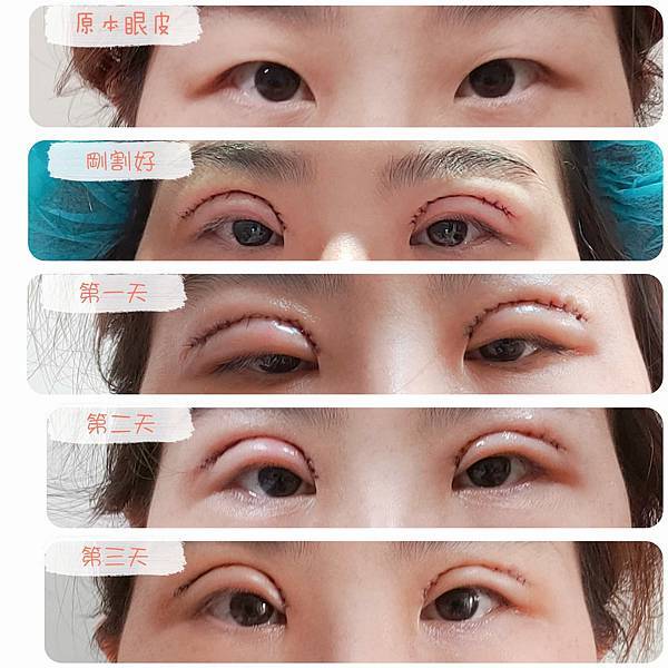 割双眼皮恢复与手术 (4).jpg
