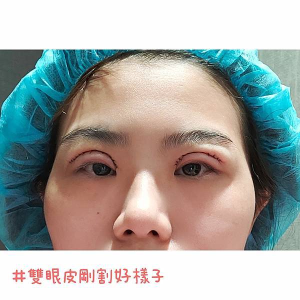 割双眼皮恢复与手术 (6).jpg
